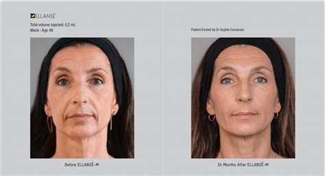 Traditional dermal fillers are only designed to address lines, wrinkles and folds. . Ellanse treatment